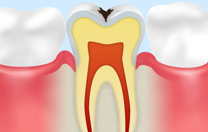 C1：初期の虫歯で歯の表面を覆うエナメル質にトラブルがある状態