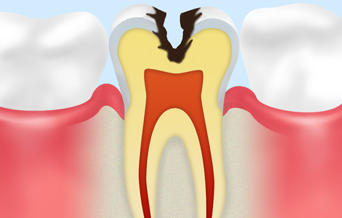 C2：虫歯が象牙質にまで達した状態