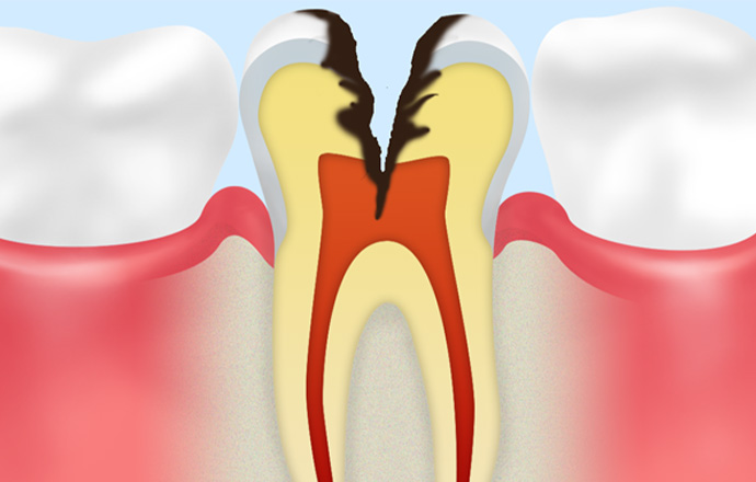 C3：歯髄（歯の内部の神経や血管がある部分）まで虫歯が進行している状態