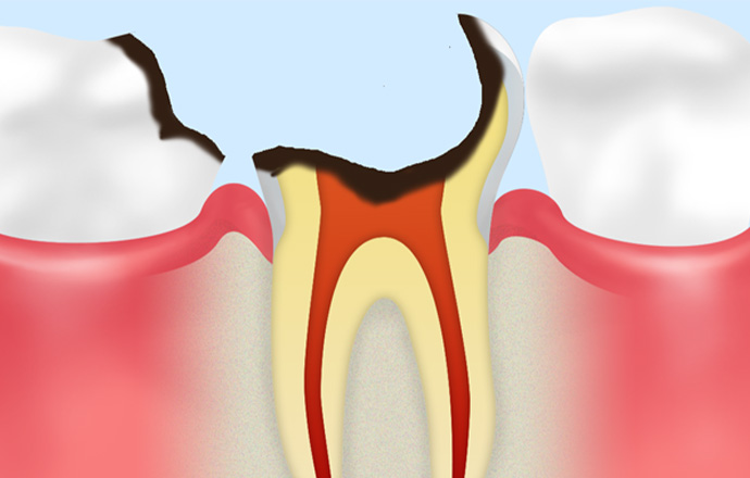 C4：虫歯菌が骨まで進行し治療による回復が見込めない状態