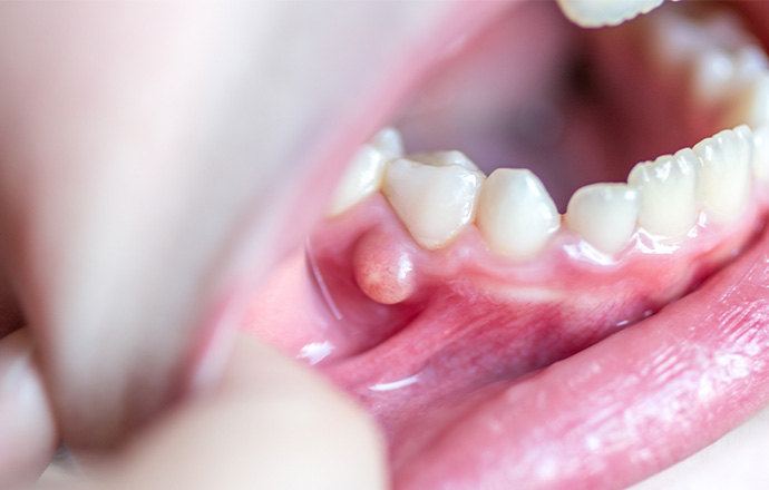 口腔の腫瘍