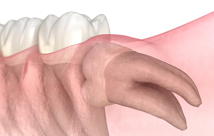 埋伏歯など難易度の高い親知らず抜歯も対応可能