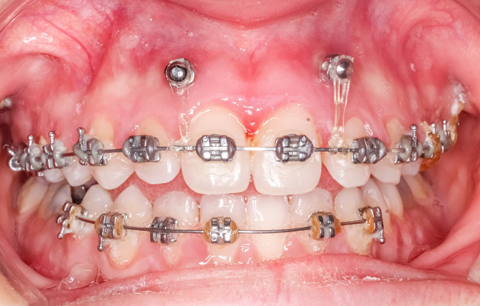 短期間で歯を動かせるインプラント矯正にも対応