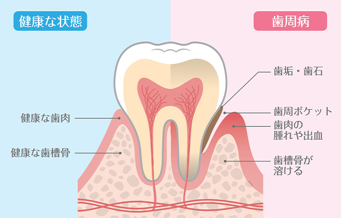 歯周病について