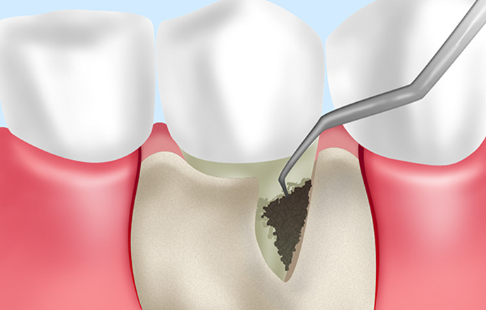 歯周外科